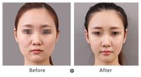 矯正牙齒需預(yù)估費(fèi)用？費(fèi)用注意事項(xiàng)解析！