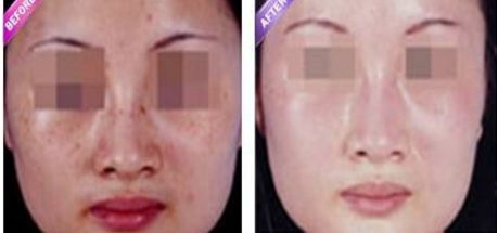 激光縮陰是否會(huì)導(dǎo)致副作用？找到安全有效的解決方法
