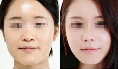 激光去除眼袋，持久效果有多久？?jī)r(jià)格如何，眼周抗衰秘笈大揭示