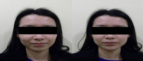 上瞼下垂手術的關鍵要素及事前事后的注意事項