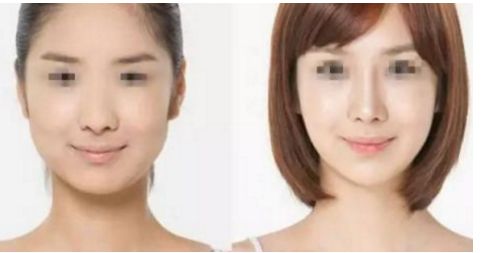 威寧隆胸手術(shù)效果如何？術(shù)后持久無需擔(dān)心！