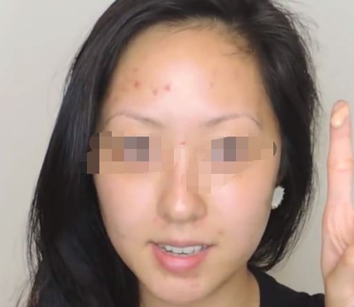 延長透明質(zhì)酸隆鼻效果，多種小竅門讓您保持完美鼻形