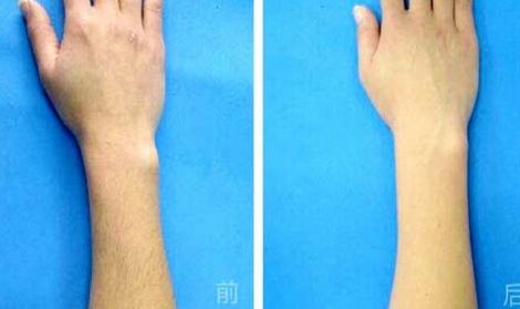 腹部吸脂手術(shù)是否存在副作用？