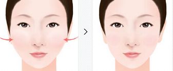 年輕人瘦臉手術(shù)不同等級(jí)全面對(duì)比