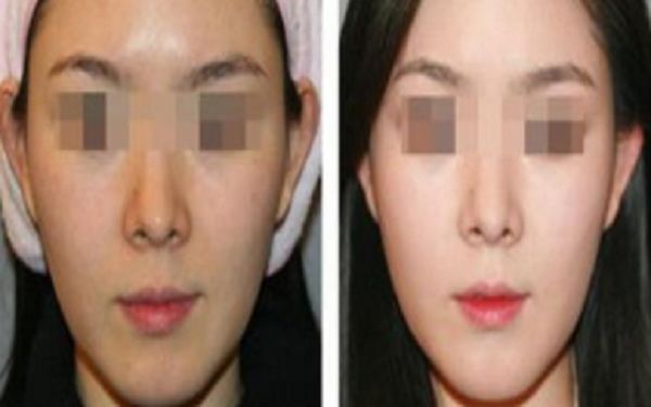 假體隆鼻價(jià)格、效果及相關(guān)信息