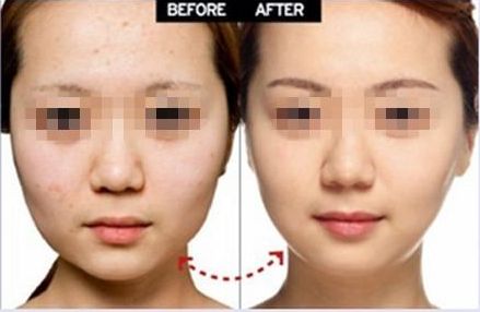 開外眼角手術(shù)：提升臥蠶、增大眼睛，效果有多好？