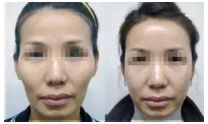 SMAS除皺是安全高效的解決皺紋問題的神奇術(shù)