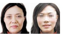 保證隆鼻修復手術(shù)安全，專業(yè)的技術(shù)保駕護航