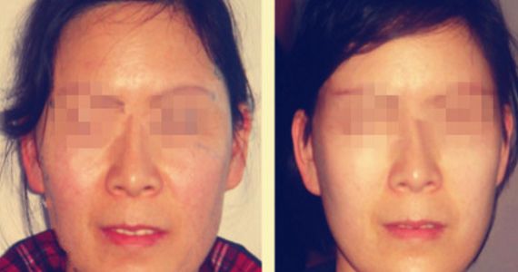 opt光子嫩膚費(fèi)用及價(jià)格查詢?cè)斀?，了解opt光子嫩膚真實(shí)價(jià)格與口碑評(píng)價(jià)