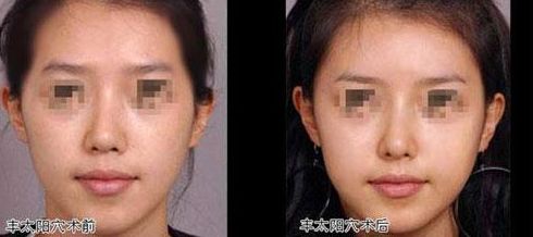 腿部吸脂整形的費用及恢復時間