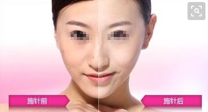 耳朵重塑技術(shù)是否優(yōu)質(zhì)？整形手術(shù)費(fèi)用如何評(píng)估？