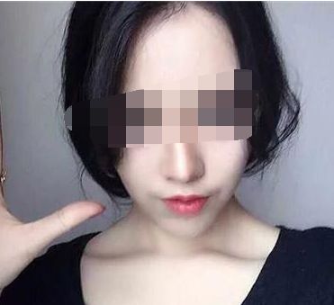 穆雄錚顴骨整形手術(shù)解析，修復(fù)顴弓美麗重生！顴骨整形術(shù)后恢復(fù)時間淺析