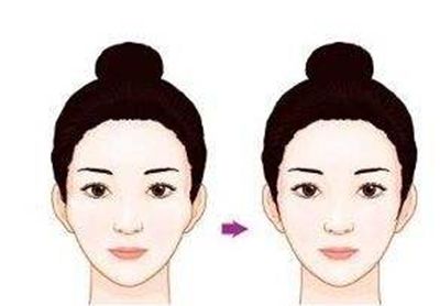 蘇州隆鼻手術(shù)費(fèi)用及效果如何？