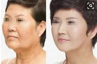 15歲女孩整容成果驚人！爸媽都認(rèn)不出來了