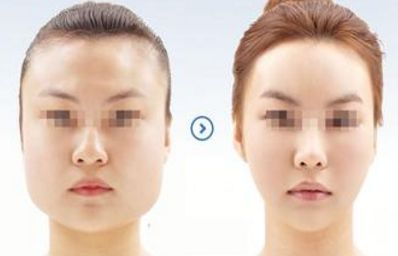 施爾美上瞼松弛矯正：修正眉形，讓你擁有迷人雙眼！