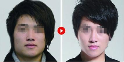 隆鼻修復，如何科學達到理想效果？