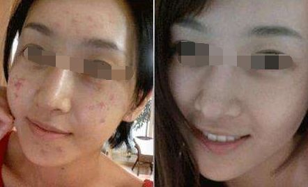 腿部吸脂術(shù)后出現(xiàn)腳腫現(xiàn)象，如何緩解？