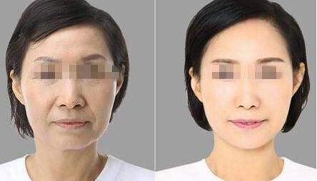 消除眼袋黑眼圈的實用方法及注射透明質(zhì)酸恢復(fù)時間