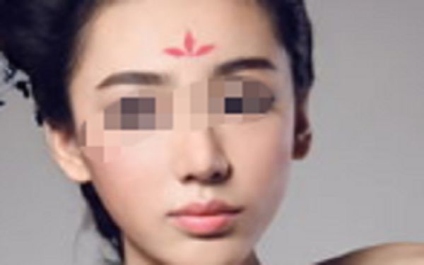 廣州膨體隆鼻價格及效果解析