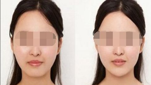 雙眼皮修復(fù)的方法有哪些？解析雙眼皮修復(fù)技術(shù)簡介