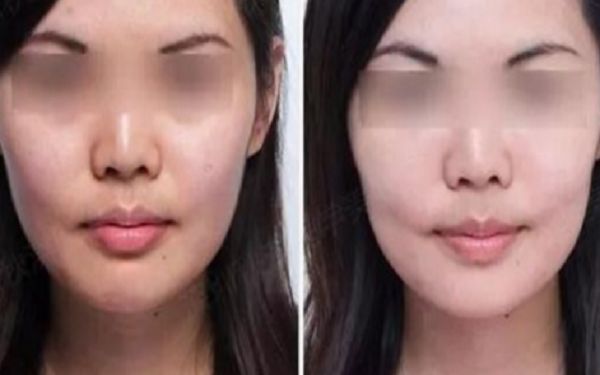 35歲采用超聲療程好還是熱瑪吉更好？匿名評測揭秘！