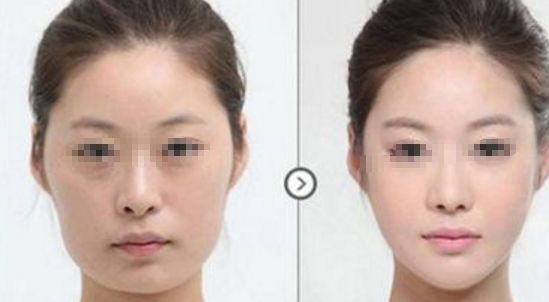 皮膚松弛，如何選擇適合的醫(yī)美項目？熱門方式如熱瑪吉、拉皮等對比解析！