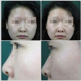 處女膜修復(fù)術(shù)最佳時機推薦