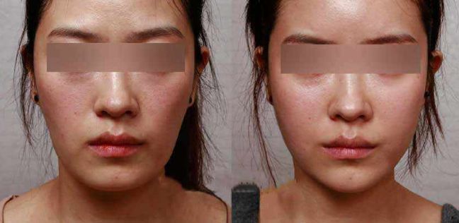 眼袋手術(shù)后效果持續(xù)多久？解析專家分享
