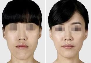肋骨隆鼻后的面部消腫需要多長時(shí)間？消腫小竅門曝光！