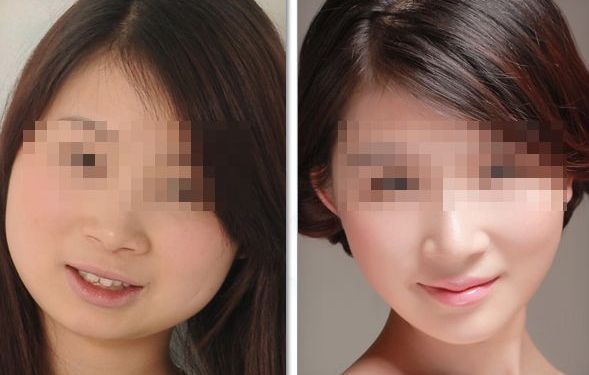 透明質(zhì)酸隆鼻：安全有效還你完美鼻型