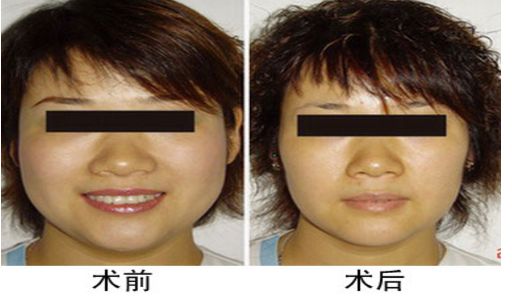 咬肌切除手術(shù)后對面部功能是否會受影響？