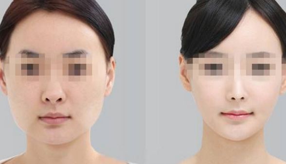 去眼袋手術(shù)后，會(huì)有疤痕嗎？術(shù)后眼部腫脹情況探析