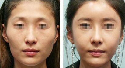 雙眼皮修復的關(guān)鍵時期，如何有效解決手術(shù)失敗問題？