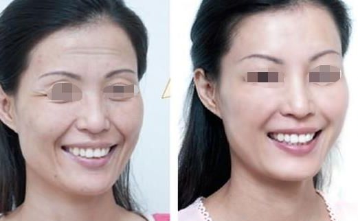 面部吸脂瘦臉效果如何？達(dá)到自然效果的關(guān)鍵是什么