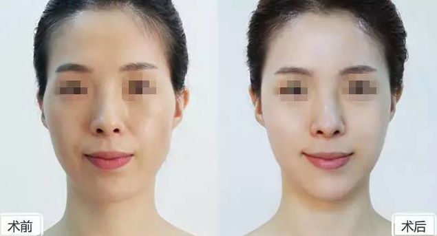 假體隆胸保持持久效果有多久？假體隆胸2個月后是否固定？