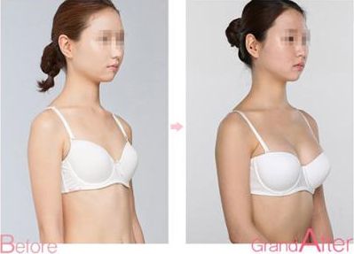 成都耳軟骨復(fù)合隆鼻手術(shù)：專家解析耳軟骨隆鼻效果及價(jià)格、術(shù)后護(hù)理