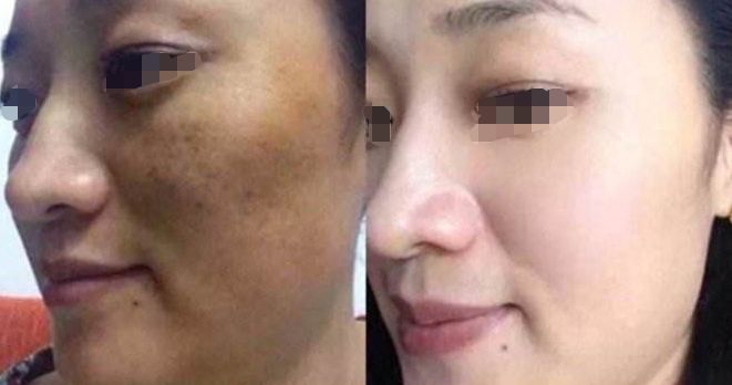 淚溝填充：熊貓針VS膠原蛋白，手術(shù)過程與注意事項解析