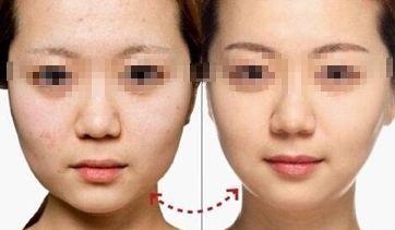 陰道緊縮術(shù)療程多久見效？