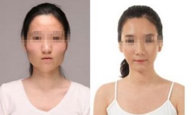 開眼角手術：完美改善眼部形態(tài)的秘密解析