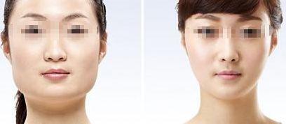 有效去除咬肌的兩種方法，輕松擁有優(yōu)美小臉