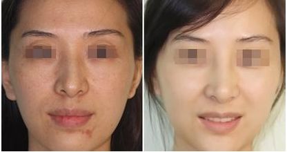 假體隆胸后會不會導(dǎo)致乳房下垂？假體隆胸的適當(dāng)護(hù)理方式是什么？