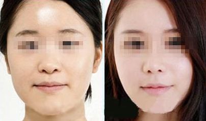 激光祛胡脂肪堆積有安全風(fēng)險(xiǎn)？您了解情況嗎？