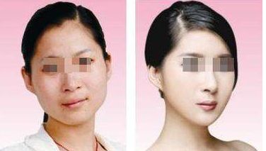 假體隆乳會(huì)對身體造成什么危害？隆乳須知一覽