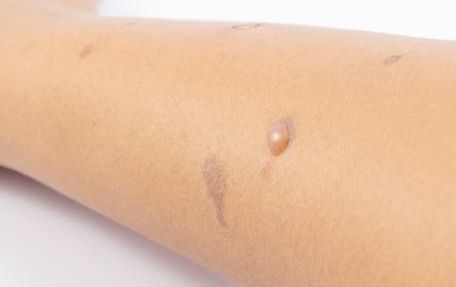 哈爾濱宋桂霞醫(yī)生為您解析雙眼皮手術的獨到體驗 哈爾濱宋桂霞醫(yī)生為您解析雙眼皮手術的獨到體驗