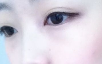 劉月麗醫(yī)生的雙眼皮修復技術在鄭大二附院備受矚目 劉月麗醫(yī)生的雙眼皮修復技術在鄭大二附院備受矚目