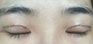上海王會勇醫(yī)生鼻部整形案例分享：創(chuàng)新技術(shù)助您獲得完美鼻型！