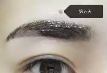南昌美伊爾劉立軍醫(yī)生膨體隆鼻整形費(fèi)用？手術(shù)效果如何？帶您看醫(yī)生案例