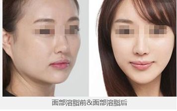 鄭州望京張鵬隆鼻2023年實(shí)力及成功案例公開，讓您放心無憂