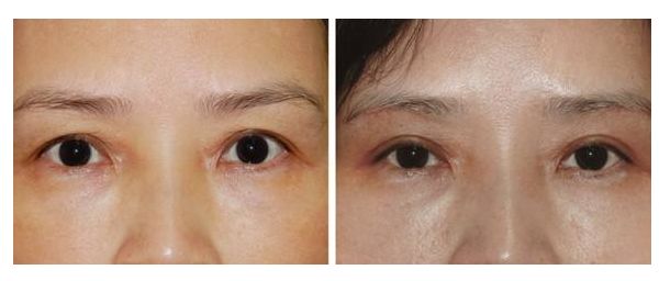 女生變成網紅臉需要多少投入？解析投資成本及效益