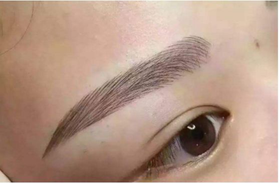 武漢葉子榮做拉皮的療效如何？專家醫(yī)生分享經(jīng)典案例